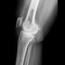 Bone Cancer Medlineplus