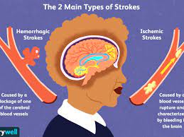 Stroke is a leading cause of death in the united states and is a major cause of serious disability for adults.1,2 about 795,000 people in. Stroke Causes And Risk Factors