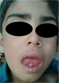 Ludwig's Angina Following Frenuloplasty in a Child: A Case Report with a  Brief Review of the Evidence