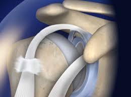 Image result for SLAP Lesion