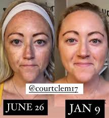 Does panoxyl help with acne and oil control?