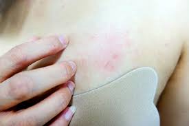 Image result for heat rash under breasts