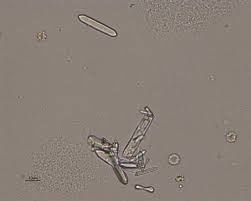 Calcium Oxalate Monohydrate Picket Fence Eclinpath Picket Fence Fence Calcium