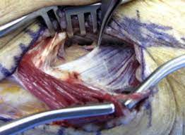 Radial Tunnel Syndrome Hand Orthobullets