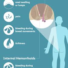 hemorrhoids signs symptoms and complications