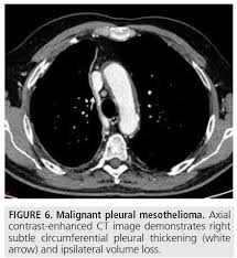 The journal of thoracic disease indicates that not only does mesothelioma show up on a ct scan, but it is the preferred diagnostic tool of choice for advanced stage mesothelioma cases. Diagnostic Imaging And Workup Of Malignant Pleural Mesothelioma