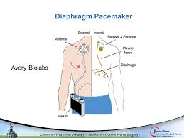 Comprehensive Surgical Management Of The Paralyzed Diaphragm Ppt Video Online Download
