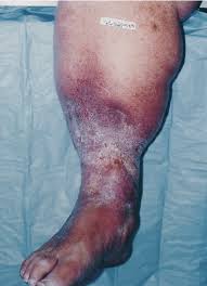 Image result for Lipodermatosclerosis