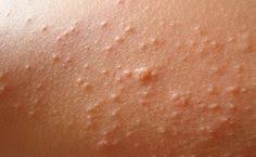 If Your Kidney Is Failing Your Body Will Give You These Clear Signs Itchy Rash Itchy Body Body Rash
