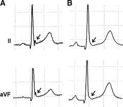Image result for Early Repolarization