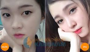 Kết quả hình ảnh cho bấm mí hàn quốc