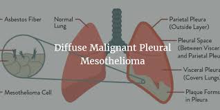 About 1% of people with . Causes Of Mesothelioma Diffuse Malignant Pleural Mesothelioma