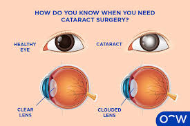 Image result for Cataract Extraction