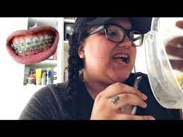 To remove braces from teeth, you need special dental tools and should consult a specialis. How To Remove Braces At Home Youtube