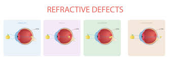 Image result for Refractive Error