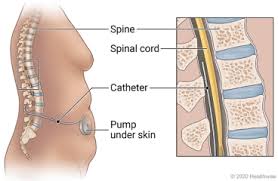 Image result for Intrathecal Pump