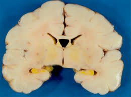 Image result for Kernicterus