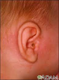 How to determine if you have a ruptured eardrum? Ruptured Eardrum Information Mount Sinai New York