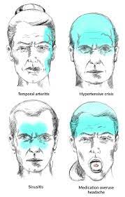 Research has shown that a lack of rem sleep causes an increase in proteins that trigger pain, resulting in chronic migraine. Case 26 Headache Amboss