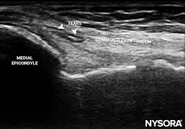 Image result for Epicondyle Injection