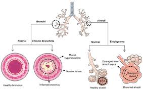Molecular Mechanisms and the Interplay of Important Chronic Obstructive  Pulmonary Disease Biomarkers Reveals Novel Therapeutic Targets