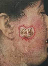 Check spelling or type a new query. Lupus Vulgaris Keyword Search Science Photo Library