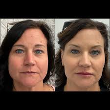 One year of consistency, care, and small changes can make such a  difference. ✨ These photos are taken a year apart. Over time, Christy has  added in gradual treatments—cheek and lip filler,