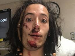 Fundraiser for Quinlan Berry by Claire Berry : Mandible Fracture Surgery  for Quinlan