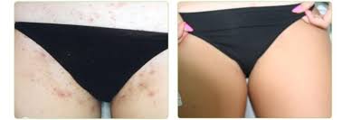Hair becomes ingrown when it grows sideways and curls back into the skin. How To Prevent Ingrown Hairs In Bikini Area Ketchbeauty