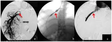 Outcomes Of Endovascular Interventional Therapy For Primary Budd Chiari Syndrome Caused By Hepatic Venous Obstruction