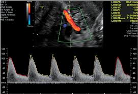 transvaginal ultrasound showing the uta doppler uta is