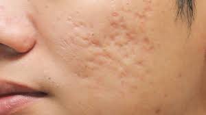 Here's how to get rid of back acne. Boxcar Scars Home Treatments Causes And Outlook
