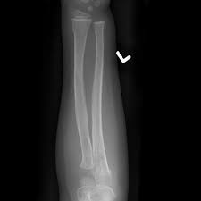 Check spelling or type a new query. Torus Fracture Radiology Reference Article Radiopaedia Org