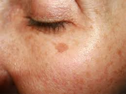 It's rich in alpha hydroxy acid which helps to lighten blemishes. 5 Different Types Of Skin Blemishes On The Face And Its Treatments Skinkraft