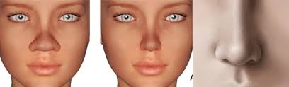 The cost of rhinoplasty varies from rs. Rhinoplasty Nose Reshaping Surgery Nose Reshaping Surgery
