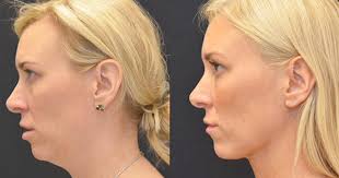 Ensayo de mujer que se hizo una liposucción a pesar de ser talla 0 se  vuelve viral (FOTOS)