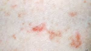 Image result for scabies on humans