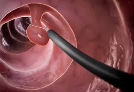 Bowel cancer, also known as colorectal cancer, usually affects the large intestine. Are All Colon Polyps Precancerous Or Worse Honorhealth