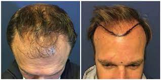 Ik wil duidelijk maken dat ik niet zien wat er gebeurd met kick nadat hij de bal gooide. Deze Bv S Ondergingen Een Haartransplantatie In Turkije Mensen Denken Dat Ik Een Jongere Versie Van Mezelf Ben Showbizz Hln Be