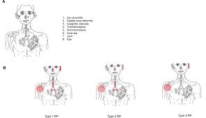 Image result for Relapsing Polychondritis