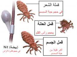 القمل التخلص من القمل الصيبان حشرات الرأس الحشرات رأس الخيمة