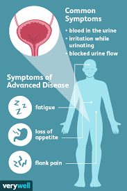 Early diagnosis of bladder cancer is crucial for improvement of cancer specific survival and recurrence rate. Verywell The Most Common First Sign Of Bladder Cancer Is Blood In The Urine Click Here To Learn More About Other Signs And Symptoms And What To Do If You Re Experiencing
