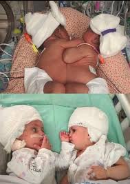 ✨ Miracle of Minal and Mirha ✨ The world held its breath as a team of  surgeons attempted the impossible — separating one-year-old conjoined twins  Minal and Mirha, born with joined heads