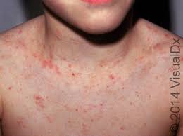 Image result for scabies human bites