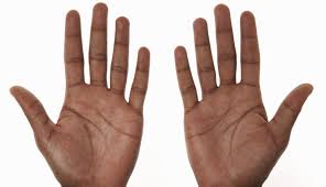 Finger Length May Predict Schizophrenia Psychiatry Advisor