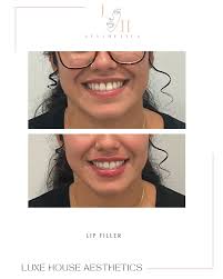 Just a boost of confidence injected 💉💋 Injector: @johnnierivera_rn . . .  . 📍Luxe House Aesthetics @luxehouseaesthetics 20 Main Street Port  Washington NY 11059 631.505.1036 #lip #lipfiller #ａｅｓｔｈｅｔｉｃ #medspalife  #longislandlipfiller ...