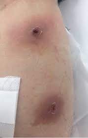 Fully grown, the human botfly ( dermatobia hominis) resembles a large bumblebee, and is botfly infestations are rarely seen in the u.s., but they are a common skin problem in central. The Korean Journal Of Parasitology