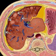 The symptoms of chronic and acute bcs may vary slightly from one another. Budd Chiari Syndrome Radiology Key