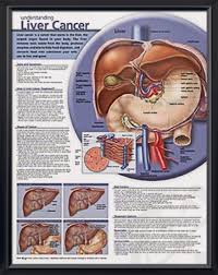 Understanding Liver Cancer Anatomy Poster Provides Visual Overview Of The Liver And Manifestations Of The Liver Cancer Liver Disease Awareness Oncology Nursing