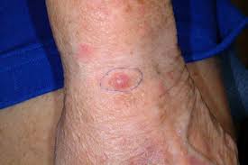 If you see something new, changing or unusual on your skin, schedule an appointment with your doctor. References In Clinical And Dermoscopic Features Of Combined Cutaneous Squamous Cell Carcinoma Scc Neuroendocrine Merkel Cell Carcinoma Mcc Journal Of The American Academy Of Dermatology